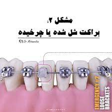 راهنمای جامع مشکلات مرتبط با براکتهای ارتودنسی و راه حل آنها