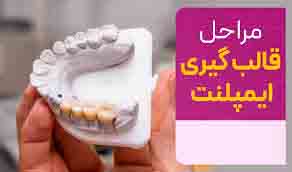 فیلم آموزشی قالبگیری ایمپلنت