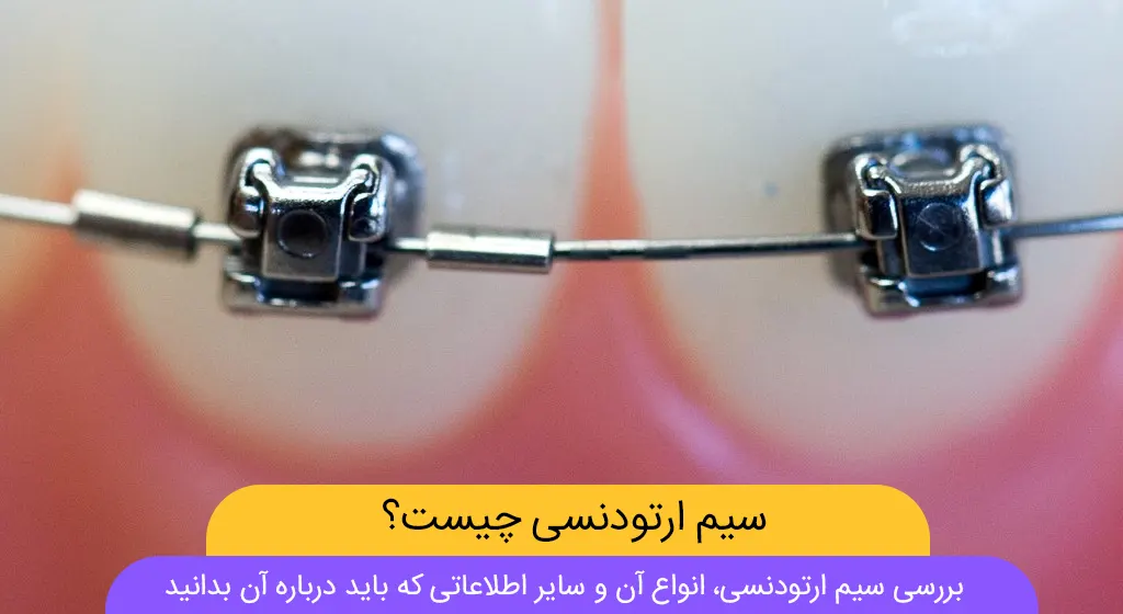 آشنایی با سیم های ارتودنسی(سیم ارتودنسی چیست و چه کاربردی دارد؟)