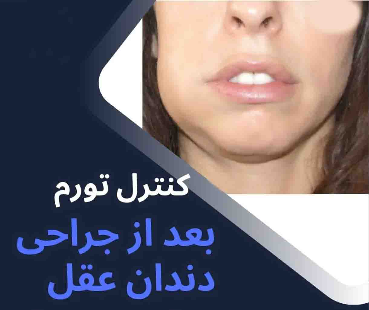 راههای کاهش تورم و درد بعد از کشیدن دندان عقل
